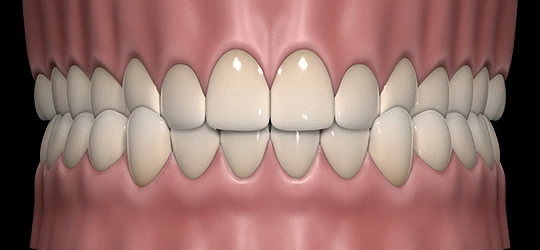 Upper teeth closing inside the lower teeth on one side of the arch