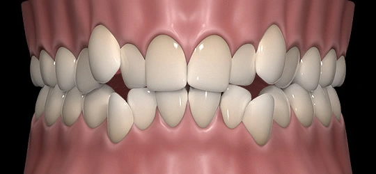 Upper front teeth overlapping each other from lack of room in the arch