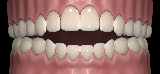 Upper and lower front teeth not meeting, leaving a gap when the back teeth close