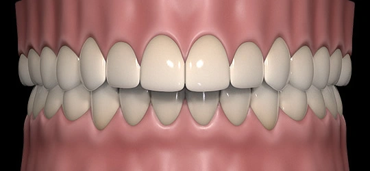 Upper front teeth overlapping the lower front teeth excessively