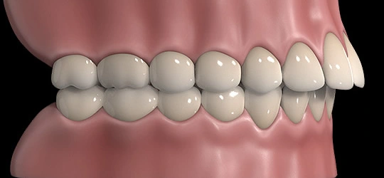 Side view of upper front teeth protruding ahead of the lower teeth