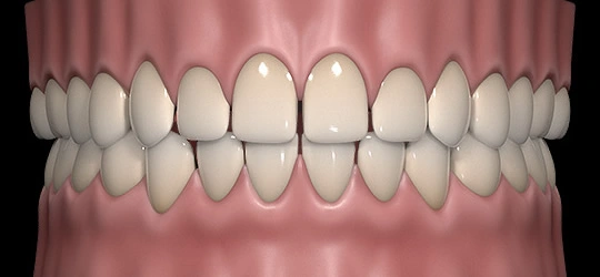 Even gaps left between the upper teeth along the arch