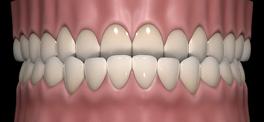 Lower front teeth sitting ahead of the upper front teeth