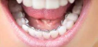 Lingual Braces