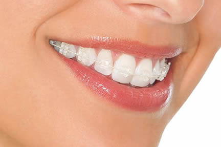 clear-braces