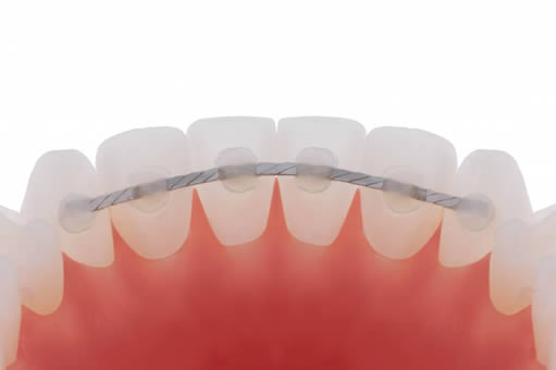 Fixed Retainer