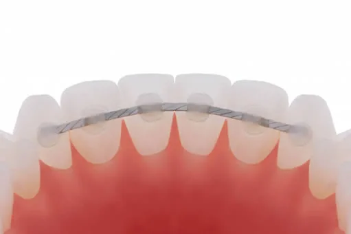 A fixed retainer bonded behind the lower teeth