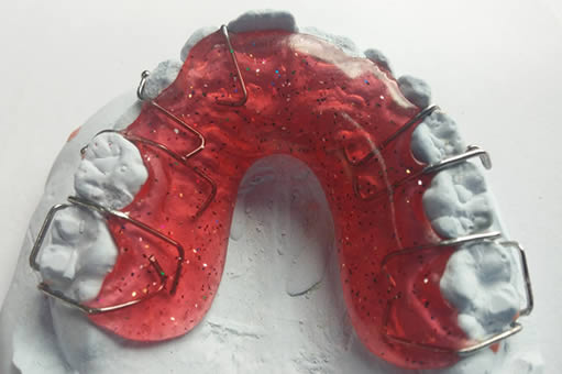 Hawley Retainer