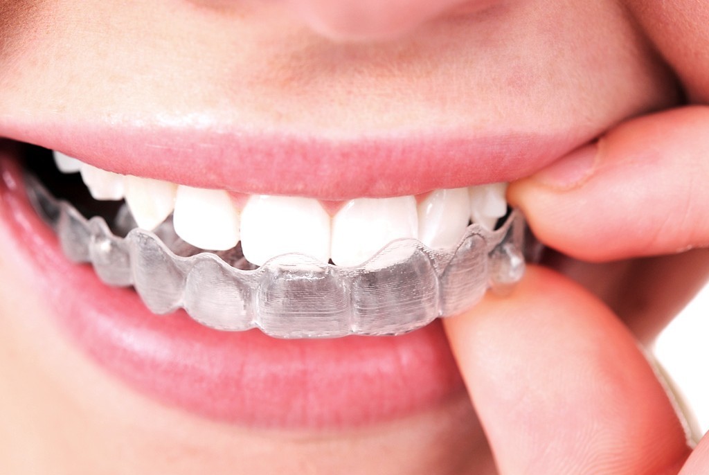 Invisalign